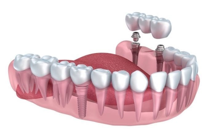 Dental-implants A longevidade e o sucesso de seus implantes dependem da sua higiene bucal (Foto: MaxFax London)