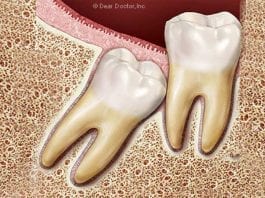 A maioria dos dentistas recomenda examinar cuidadosamente os dentes do siso (incluindo radiografias diagnósticas e outras imagens) a cada 24 meses.