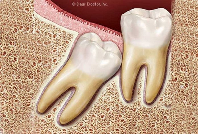 A maioria dos dentistas recomenda examinar cuidadosamente os dentes do siso (incluindo radiografias diagnósticas e outras imagens) a cada 24 meses.