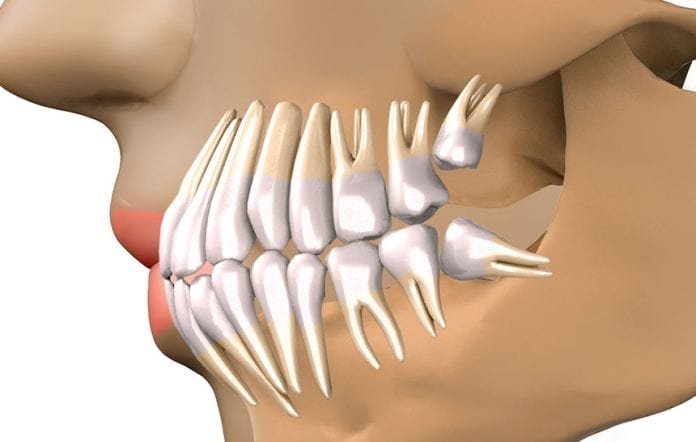 Dentes do siso - mitos e verdades Há quem afirme que a tendência do siso é desaparecer da arcada dentária das futuras gerações