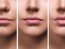 Botox, ácido hialurônico e o lip lift ajudam no rejuvenescimento