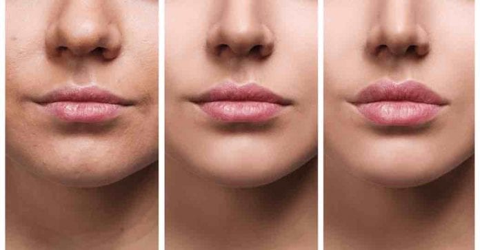 Botox, ácido hialurônico e o lip lift ajudam no rejuvenescimento