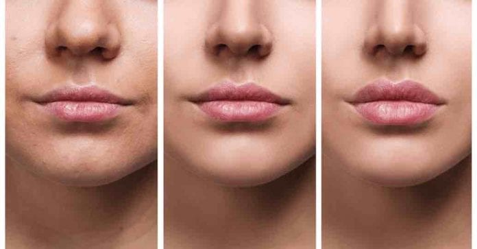 Botox, ácido hialurônico e o lip lift ajudam no rejuvenescimento Botox, ácido hialurônico e o lip lift ajudam no rejuvenescimento