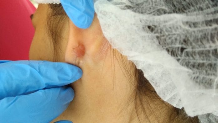Retirada de queloide - bucomaxilofacial Felipe Porto