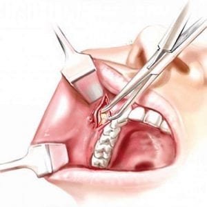 Bichectomia: A ‘bola de bichat’ pode ser removida por meio de uma cirurgia estética.