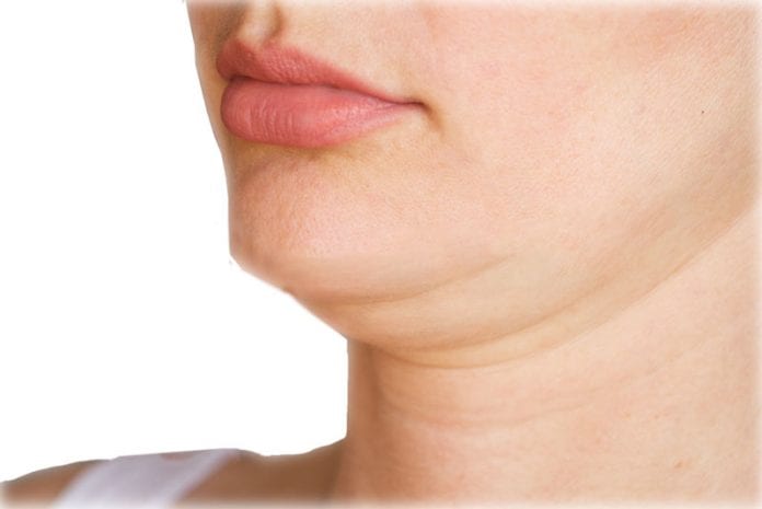 A papada pode ser removida por meio da Lipo Enzimática, um tratamento de harmonização orofacial pouco invasivo que ajuda a melhorar o contorno mandibular
