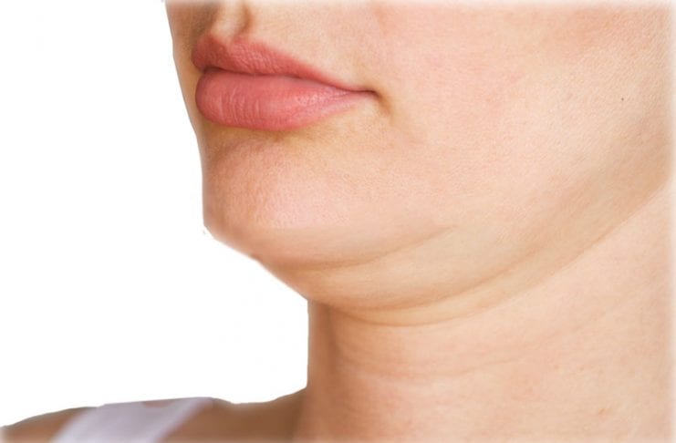 A papada pode ser removida por meio da Lipo Enzimática, um tratamento de harmonização orofacial pouco invasivo que ajuda a melhorar o contorno mandibular