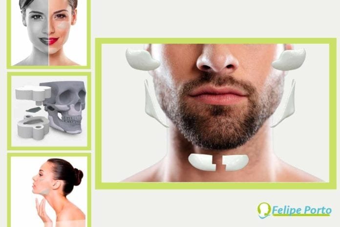 As vantagens da Harmonização Facial Definitiva são muitas: maior previsibilidade, menor tempo cirúrgico, melhor resultado estético e um implante com alta resistência mecânica (Ilustrações: site CPMH)